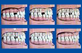 series of photos showing the process of installing a dental implant